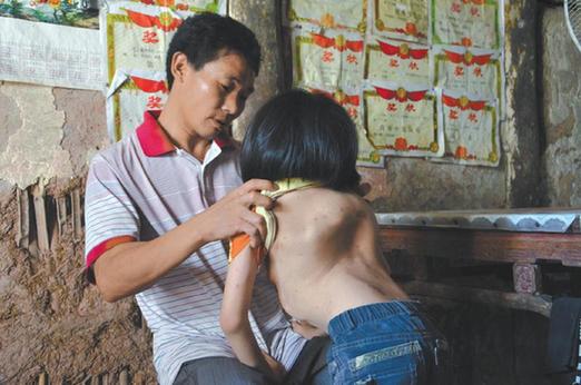 有嚴(yán)重脊椎畸形及胸腔隆突病的李文霞。