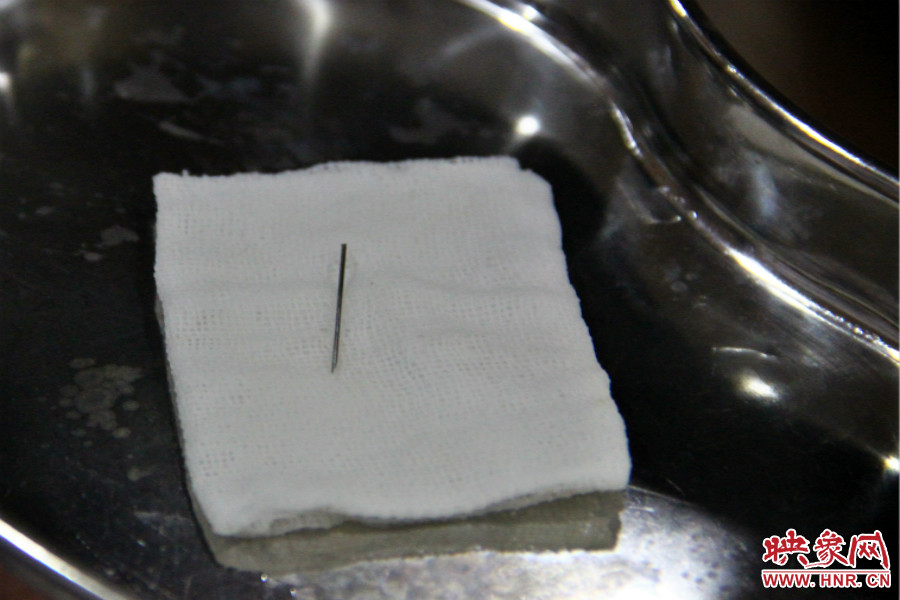 上午11點(diǎn)30分許，小龍腦中鋼針已經(jīng)成功取出。