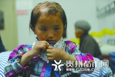 被燙傷的頭皮一直沒有愈合。