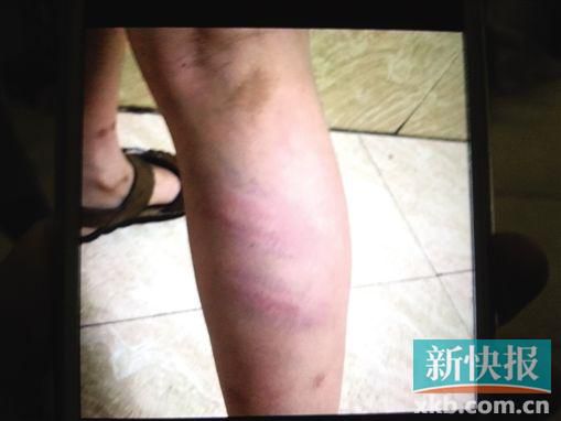 小宇腿部有明顯瘀痕。 翻拍自家屬手機
