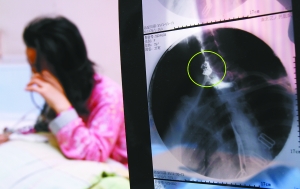 假牙上的鋼絲刺破食管，而薄薄的食道壁緊貼主動脈血管，極易造成血管破裂