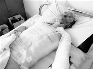 周小姐的頭、頸、軀干、四肢均被燒傷，其中面部燒傷最為嚴(yán)重。