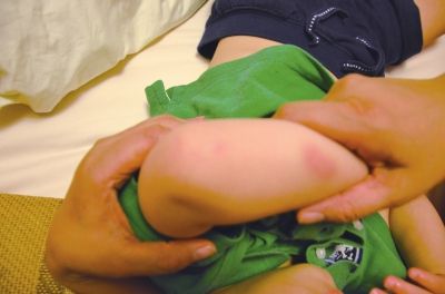 孩子身上有多處明顯傷痕。京華時報讀者供圖