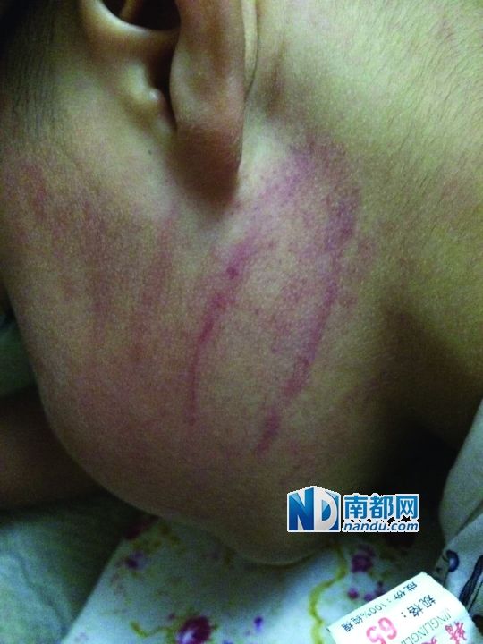 小逸臉上淤痕清晰可見。