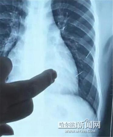 17歲少年體內(nèi)扎進(jìn)4根鋼針 1根已插入心臟4厘米 17歲少年體內(nèi)扎進(jìn)4根鋼針 1根已插入心臟4厘米