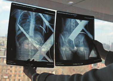 12歲女孩從6樓陽(yáng)臺(tái)墜下 身體被樓下鐵柵欄刺穿 12歲女孩從6樓陽(yáng)臺(tái)墜下 身體被樓下鐵柵欄刺穿