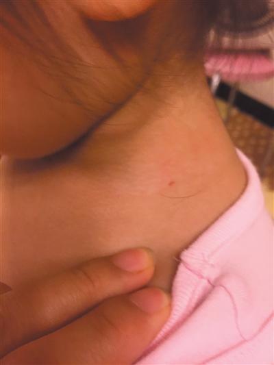 北京兩幼兒身現(xiàn)傷口稱遭老師針扎 幼兒園否認(rèn) 北京兩幼兒身現(xiàn)傷口稱遭老師針扎 幼兒園否認(rèn)