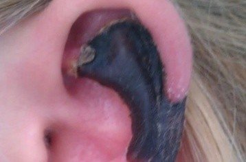 荷蘭女子旅游途中被蜘蛛咬，耳軟骨溶解變黑。