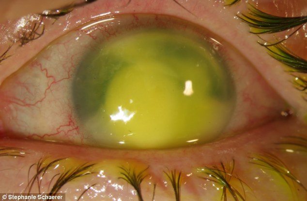 恐怖慎入！隱形眼鏡致英女子摘除眼球