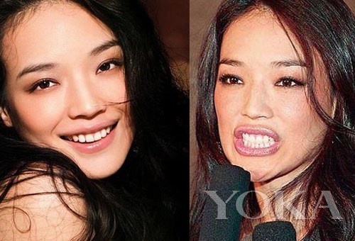 牙齒凸出，口輪肌過于松弛