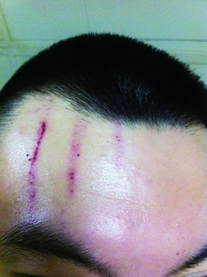 　2013年，被打者受傷照