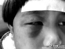 6月2日，網(wǎng)曝渭南市臨渭區(qū)一不滿5歲的女童遭奶奶毆打，眼圈青腫，引起網(wǎng)友關(guān)注，但孩子父母和爺爺均稱是摔倒導(dǎo)致。相關(guān)部門介入調(diào)查發(fā)現(xiàn)確為奶奶毆打所致，鑒于其身體原因已進(jìn)行批評教育。