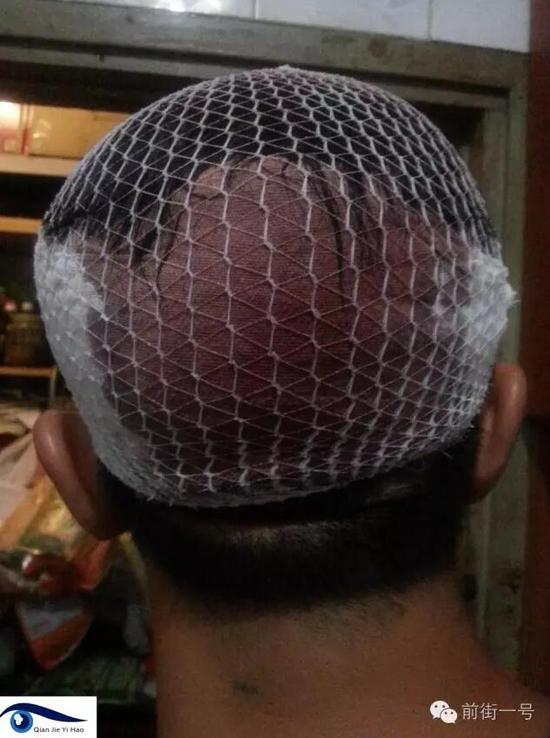 李律師受傷后縫合三針。