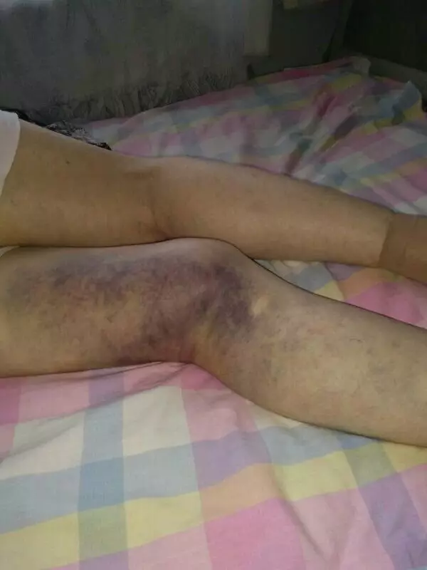 八旬老太被美容院洗腦交7萬(wàn)元 腿沒(méi)治好反病倒 八旬老太被美容院洗腦交7萬(wàn)元 腿沒(méi)治好反病倒