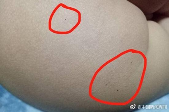 據(jù)多名紅黃藍(lán)(新天地分園)家長反映，孩子腿部、屁股、腋下出現(xiàn)針眼。