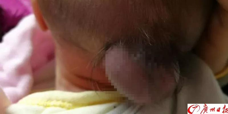 剛出生的男嬰腦袋上長(zhǎng)出尾巴 只因孕媽沒做這事 剛出生的男嬰腦袋上長(zhǎng)出尾巴 只因孕媽沒做這事
