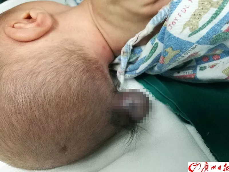 剛出生的男嬰腦袋上長(zhǎng)出尾巴 只因孕媽沒做這事 剛出生的男嬰腦袋上長(zhǎng)出尾巴 只因孕媽沒做這事