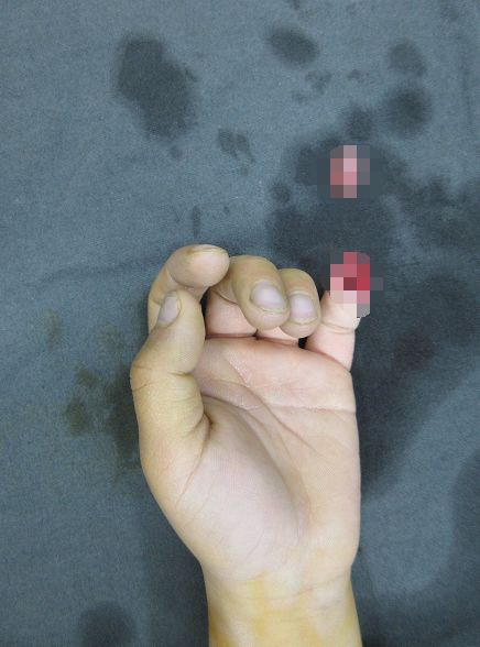 嚇哭！6歲男孩被夾斷手指 罪魁禍首竟是校服