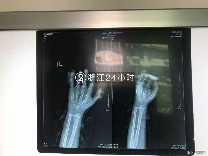 嚇哭！6歲男孩被夾斷手指 罪魁禍首竟是校服