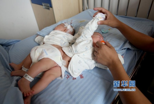 一對(duì)連體女嬰成功分離