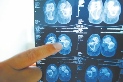 X光片顯示,確實有一根殘留的螺絲釘。