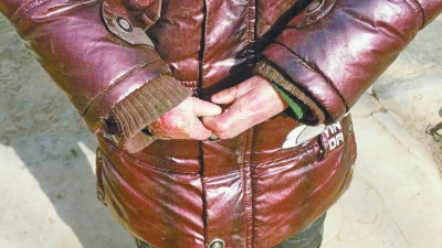 長(zhǎng)期受損的手指，已經(jīng)長(zhǎng)在了一起。