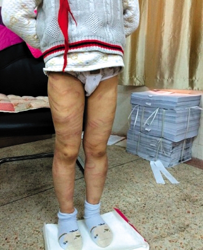 4月3日晚，微博網(wǎng)友“@朝廷半日閑”發(fā)圖文微博展示男童被虐待的慘狀。 微博截圖