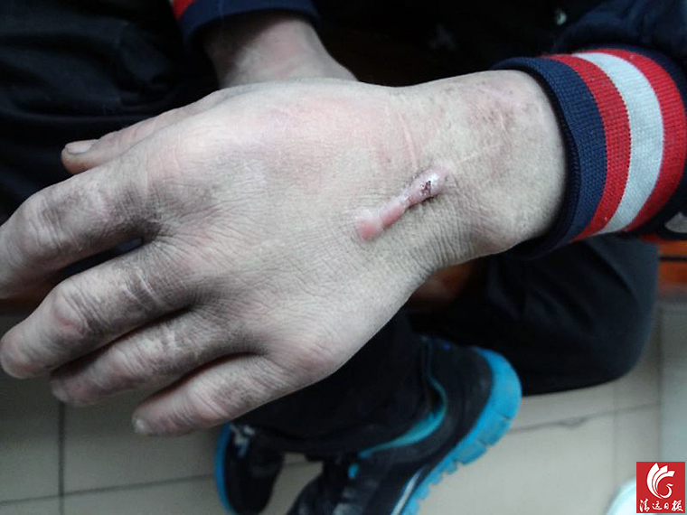 被發(fā)現(xiàn)男子手上的傷疤。