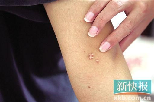 取出針后李星兒手臂留下了傷口。新快報(bào)記者 張國(guó)鋒/攝