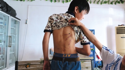 　昨日，奶西村，被打的小剛后背上條條瘀痕依然明顯。