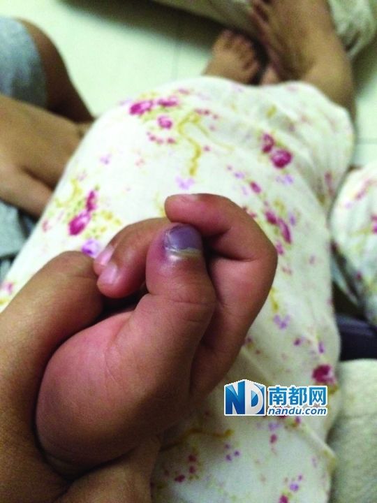 小逸手指被夾傷。