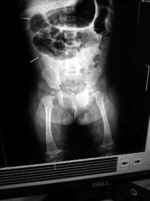 目前體內(nèi)的12根鋼針多分布在孩子的臀部，一根在腹部，其余3根在胸腔附近，其中一根很接近心臟