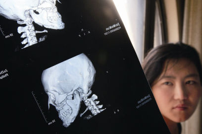 國內(nèi)醫(yī)院CT顯示，如今靳魏坤的鼻子假體是歪的，連下巴也是歪的