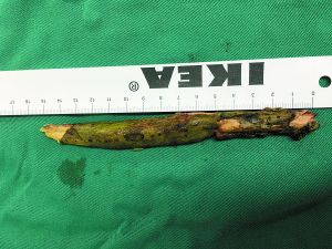 插入男子腦內(nèi)的樹(shù)枝。