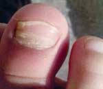 一幼兒園兒童“指甲異?！? title=