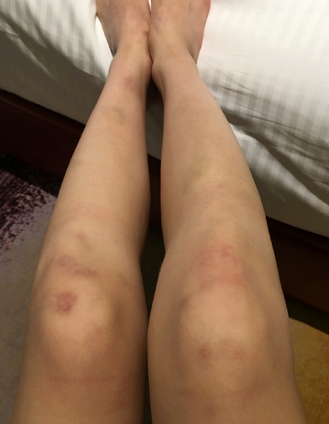 沈夢辰曬傷腿 沈夢辰曬傷腿